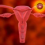 What Causes Ectopic Pregnancy in IVF