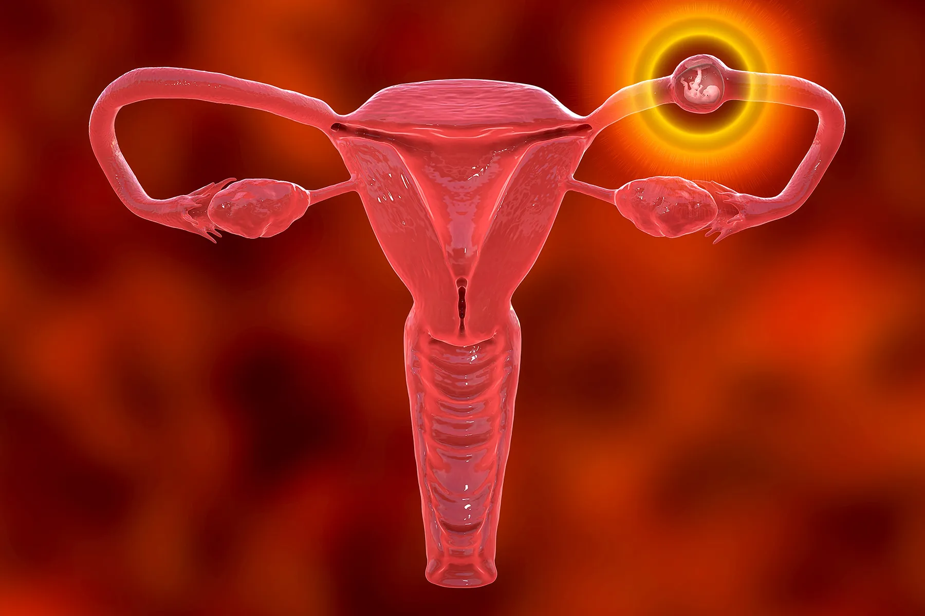 What Causes Ectopic Pregnancy in IVF
