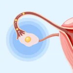What Causes Premature Ovulation During IVF