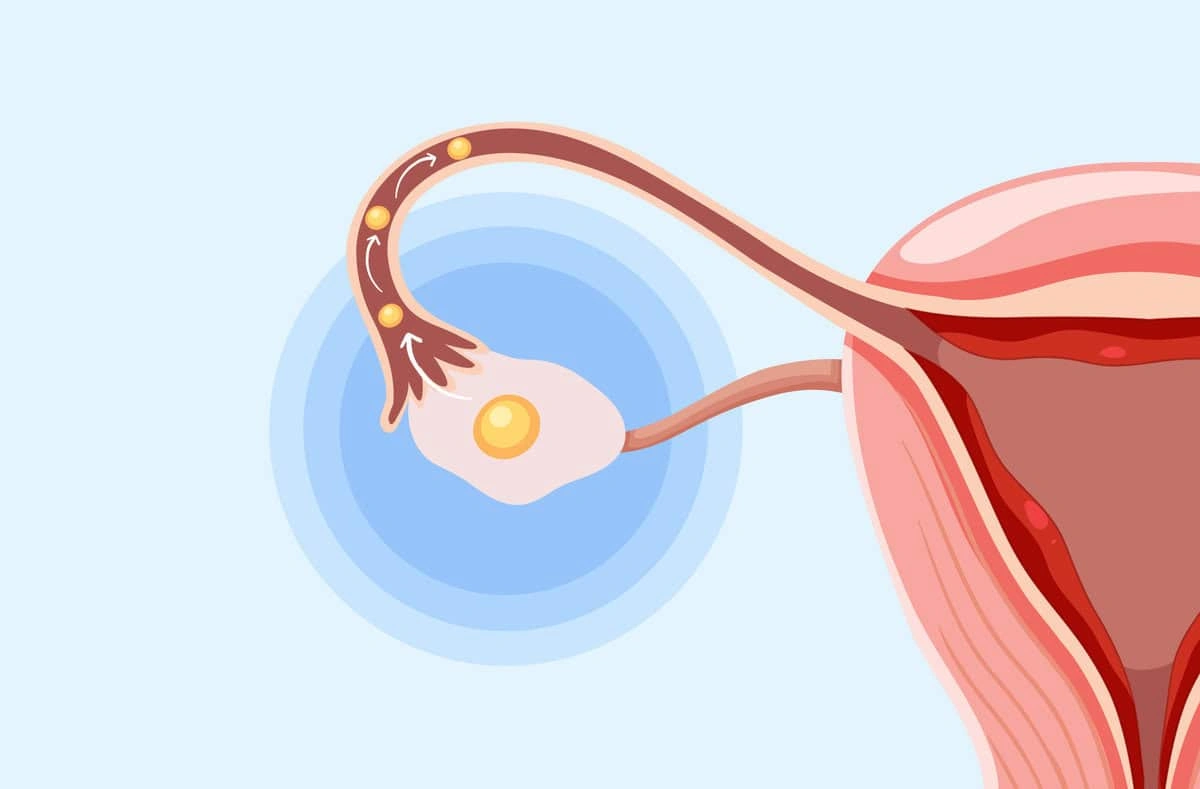 What Causes Premature Ovulation During IVF