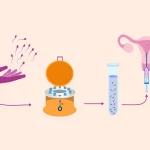 What Is IUI Process