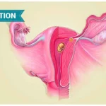 When Does Implantation Occur After IUI